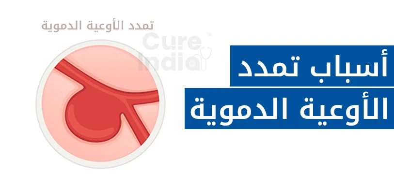 اسباب تمدد الاوعية الدموية